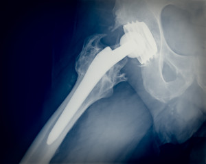 Permanent total hip arthroplasty xray